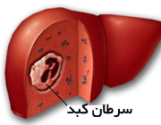 چگونه با رفتار های غلط مبتلا به سرطان کبد می شویم؟/ علائم ،نشانه ها و راهکار های پیشگیری