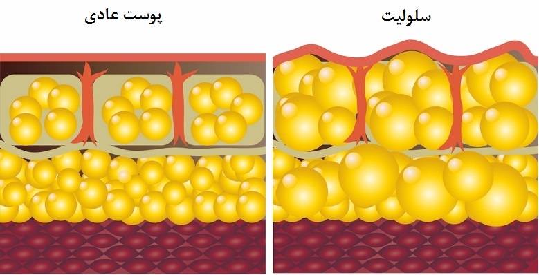 چرا سلولیت در بخش‌های خاصی از بدن شکل می‌گیرد؟