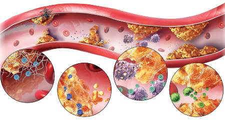 نانوذرات با تصلب شرایین مقابله می کنند