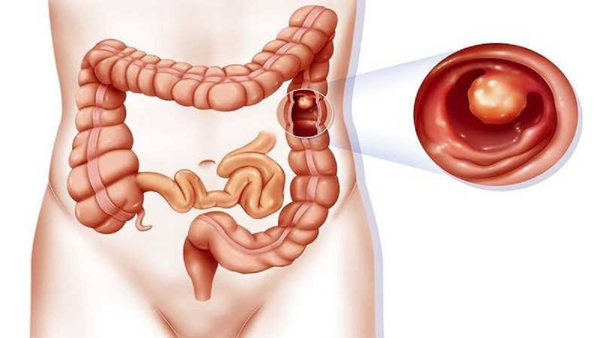 چگونه از این سرطان شایع پیشگیری کنیم؟!